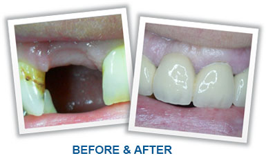 Replace Missing Teeth